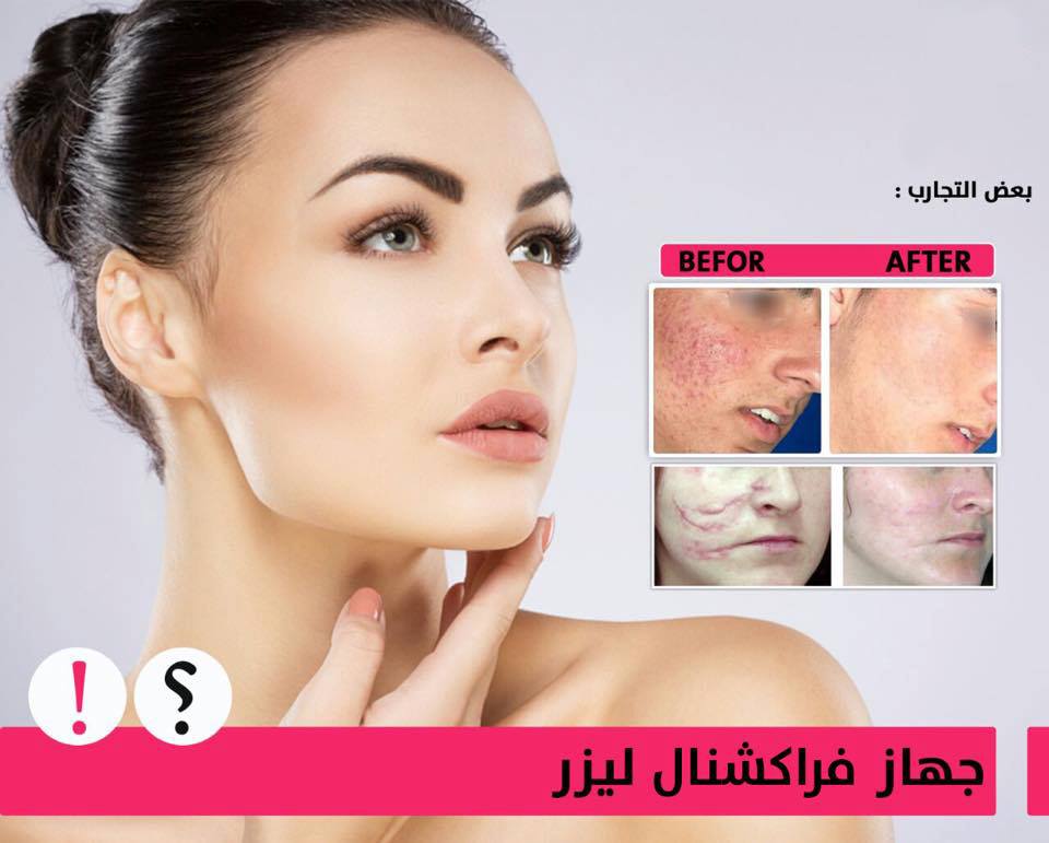 الفراكشنال ليزر تقنية تجميل البشرة